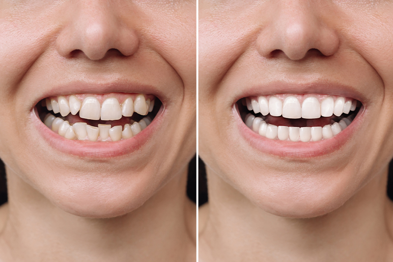 Zähne vor und nach dem Anbringen der Veneers